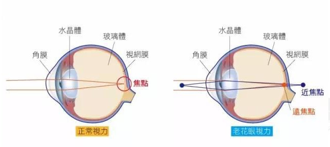 白內(nèi)障和老花眼區(qū)別,，老花眼發(fā)病率正呈現(xiàn)年輕化趨勢(shì)