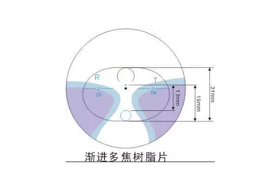 美麗島多焦鏡適合的人群，需要注意的事項(xiàng)