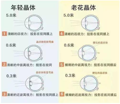 近視就不會(huì)老花了嗎？